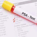PSA Test (Prostata specifični antigen)